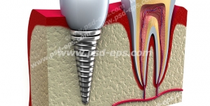 ماکت کامل دندان به اضافه آناتومی دندان و دندانی کاشته شده (ایمپلنت)