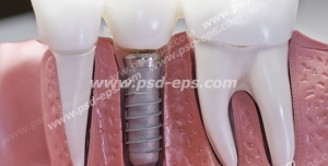 عکس با کیفیت ماکتی از دندان ها و لثه و دندان کاشته شده (ایمپلنت) ویژه استفاده در مراکز تخصصی دندان