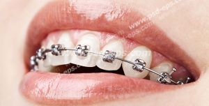 عکس با کیفیت دندان های سیم کشی شده (ارتودنسی) ثابت مورد استفاده در درمانگاه ها و کلینیک های تخصصی دندانپزشکی بخصوص پزشکان ارتودنیست
