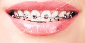 عکس با کیفیت دهانی با دندان های سیم کشی شده (ارتودنسی) ثابت مورد استفاده در درمانگاه ها و کلینیک های تخصصی دندانپزشکی بخصوص پزشکان ارتودنیست
