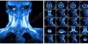 عکس با کیفیت آزمایش MRI از گردن و ستون فقرات به همراه مهره های آن جهت تشخیص بیماری دیسک گردن