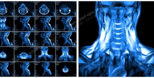 عکس با کیفیت آزمایش MRI از گردن و مهره های گردن و ستون فقرات جهت تشخیص بیماری دیسک گردن