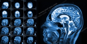 عکس با کیفیت آزمایش MRI و تصویر برداری از داخل سر و مغز و ناهنجاری های پیش آمده درون مغز