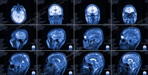 عکس با کیفیت آزمایش MRI و تصویر برداری از داخل سر و مغز و ناهنجاری ها ومشکلات پیش آمده درون مغز سر