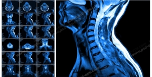 عکس با کیفیت آزمایش MRI از گردن به همراه ستون فقرات و مهره های آن جهت تشخیص دیسک گردن