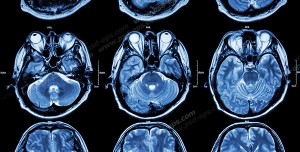عکس با کیفیت آزمایش MRI و تصویر برداری از داخل مغز سر