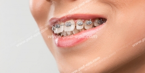 عکس با کیفیت تبلیغاتی زن لبخند بر لب و دندان های ارتودنسی شده